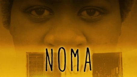 Noma